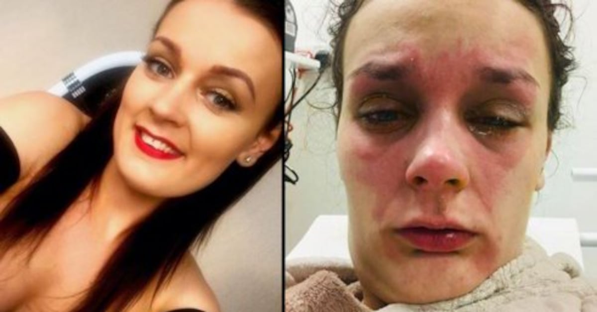 Un huevo calentado en un microondas explota y casi deja ciega a una joven