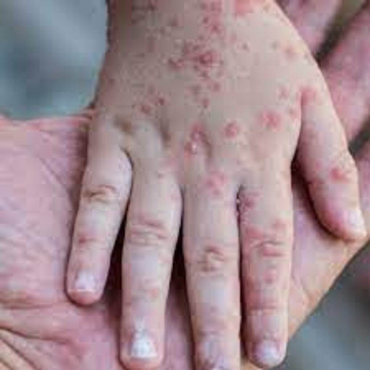 Bajan casos de viruela del mono en el mundo, pero hay un incremento en América